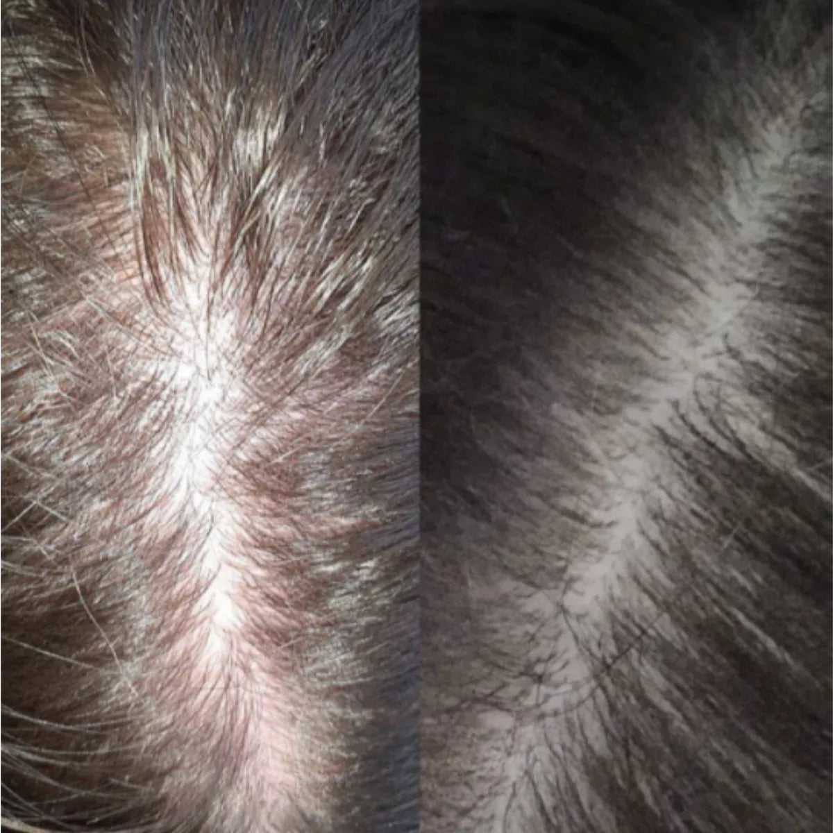 Zdjęcie przed i po: przedziałek głowy — wyraźnie gęstsze włosy i mniej widoczna skóra po 12 tygodniach kuracji HairCure.
