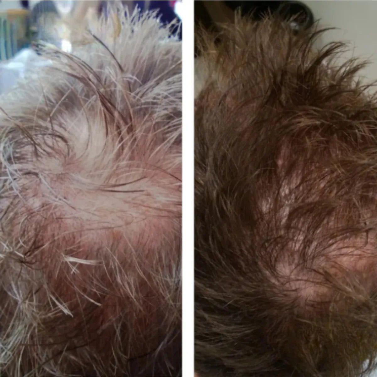 Zdjęcie przed i po: korona głowy — odbudowa gęstości włosów po 16 tygodniach kuracji HairCure.