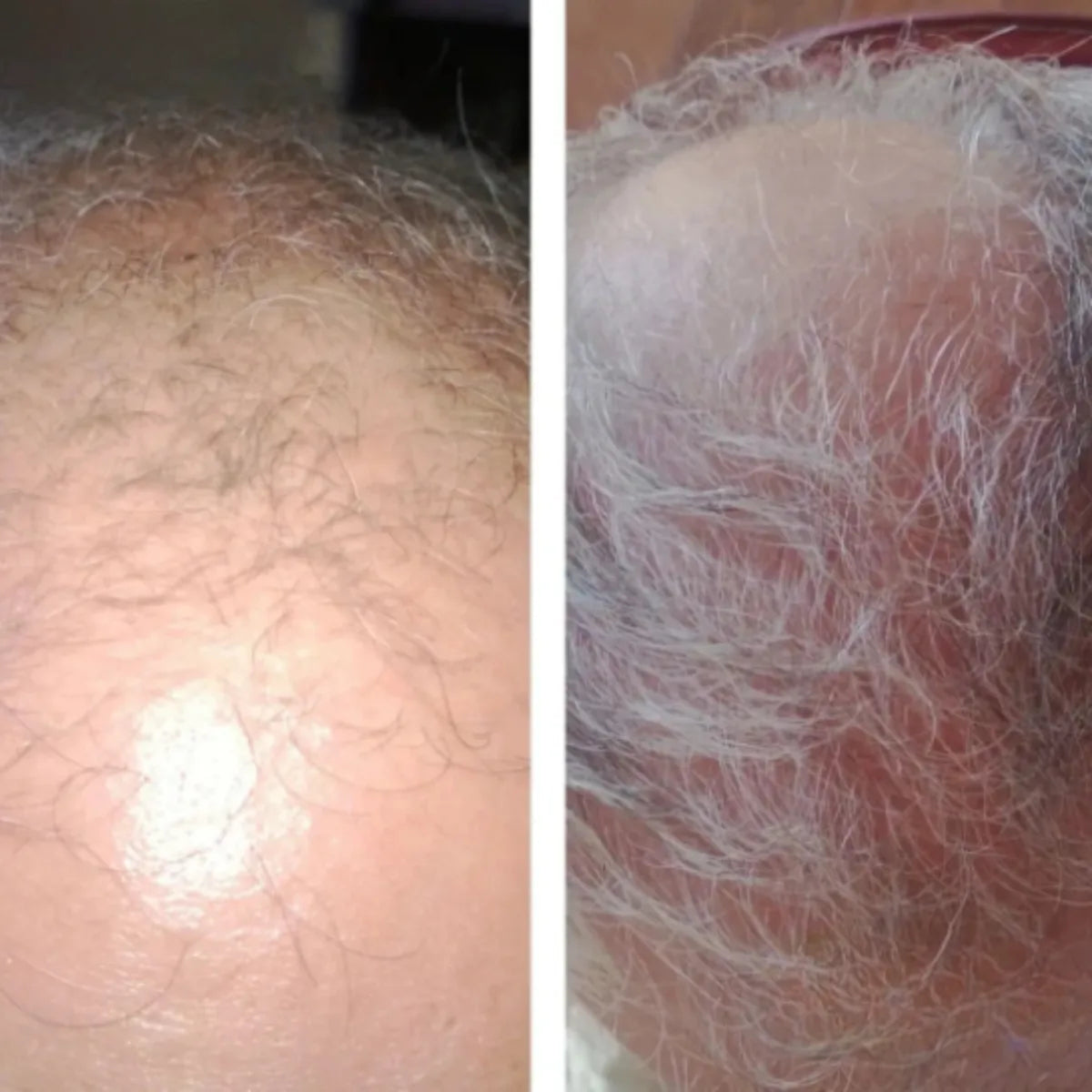 Zdjęcie przed i po: korona głowy — znacząca poprawa gęstości po 24 tygodniach kuracji HairCure.